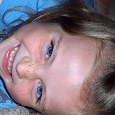 Freckles